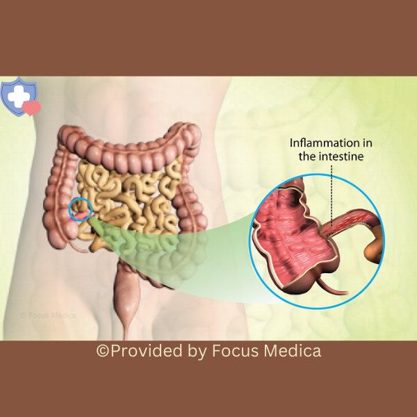 Read more about the article What Are the Early Signs of Crohn’s Disease?